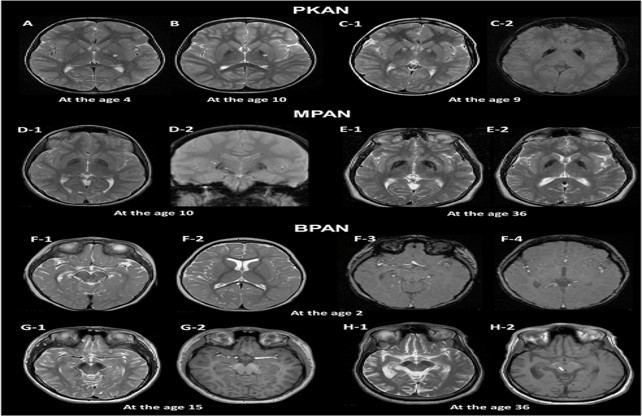 brain mri