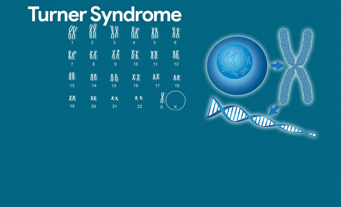 turner syndrome